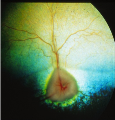 Atrofia progressiva della retina